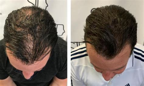 colmek+smp|Scalp Micropigmentation in Miami for Hair Loss Solutions